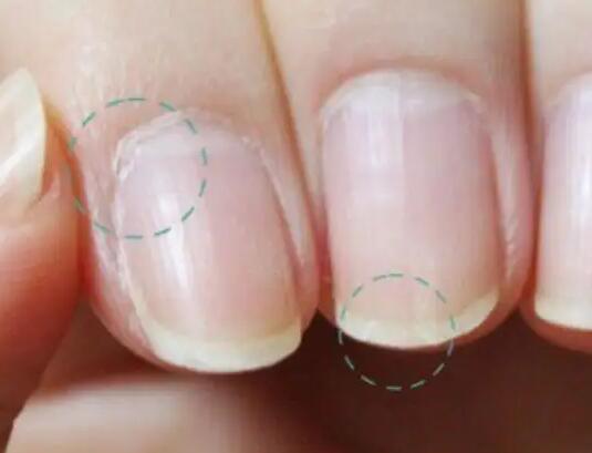 中医体质辨识仪品牌提示指甲上发生竖纹是什么原因？要正确看待